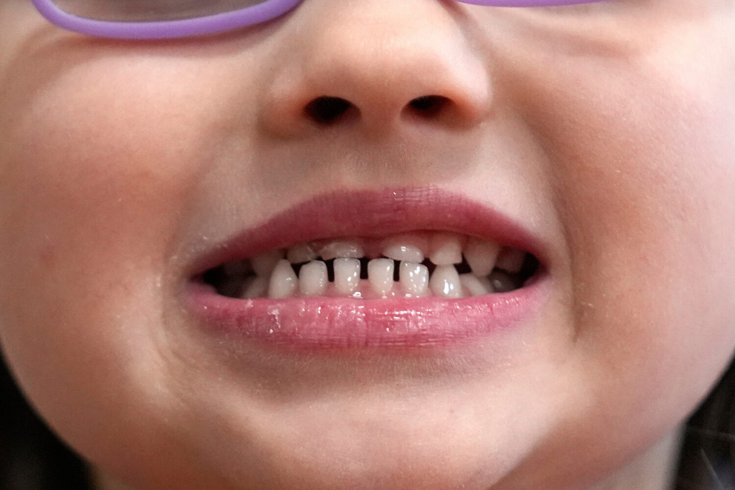 FILE - A child shows off her teeth after a dental exam in Concord, N.H., Wednesday, Feb. 21, 2024. ...